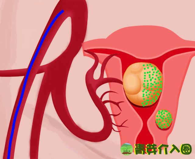 子宫肌瘤最新最好的治疗方法,子宫肌瘤最先进治疗手段