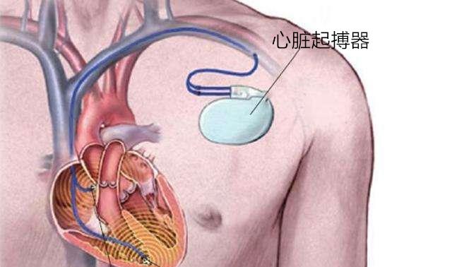 最新的起搏器,前沿科技的最新型心脏起搏器。