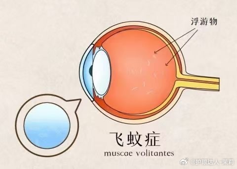 飞蚊症治疗最新突破：“飞蚊症治疗新进展”